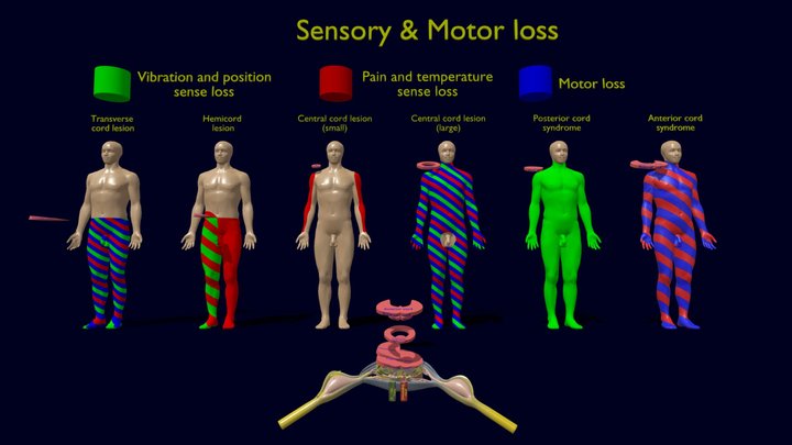 Spinal cord lesions & clinical signs & symptoms 3D Model