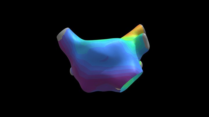 LPSV Ectopic No Lesions 3D Model