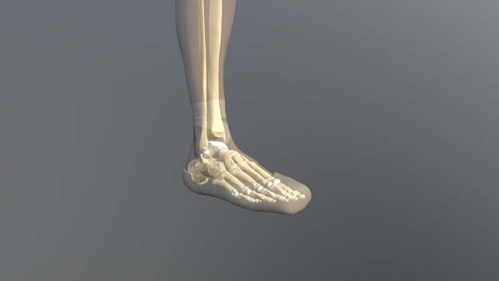 Dancer's fracture to fifth metatarsal 3D Model