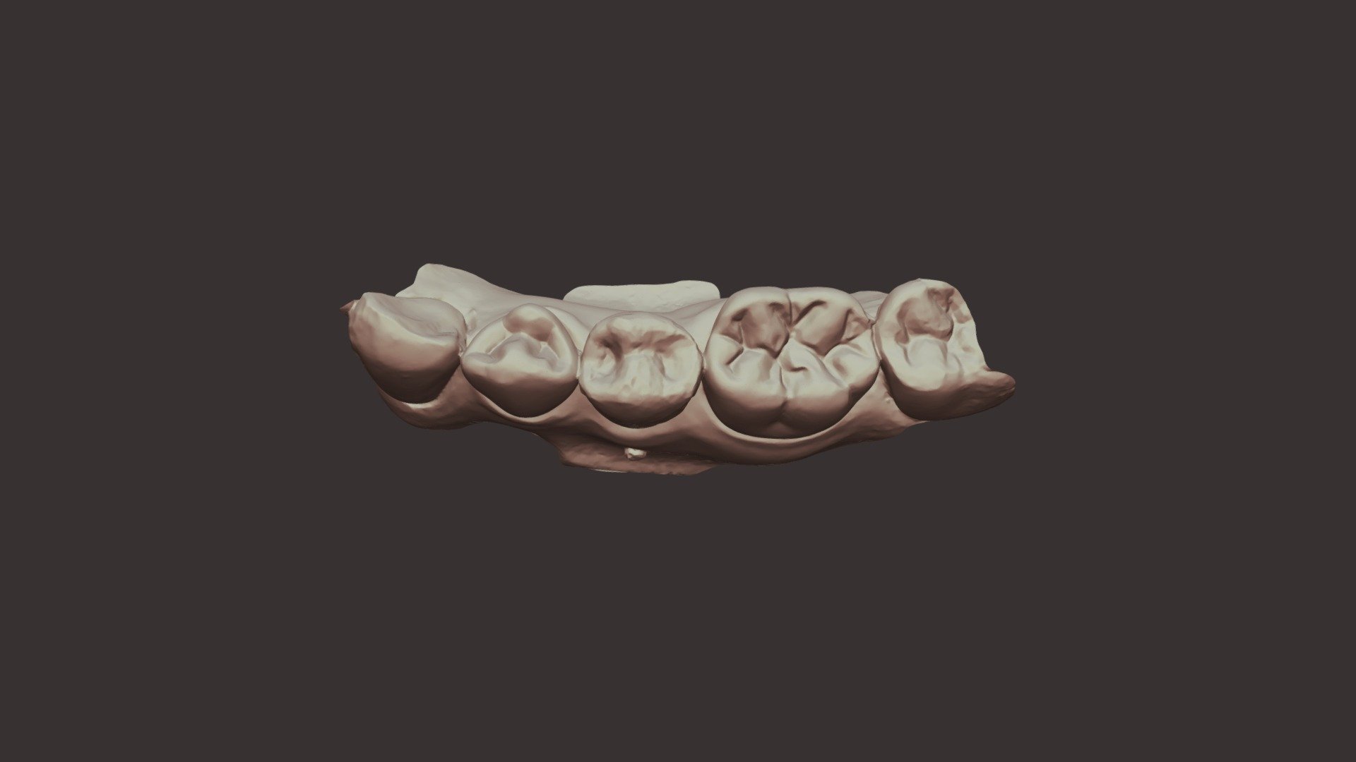 Group 14 Tooth #20-1