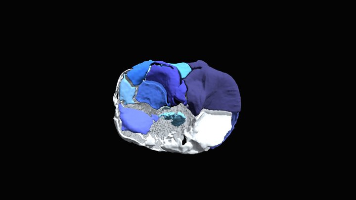 Session 4.20 | Tibial head - Extended appr. | 2 3D Model