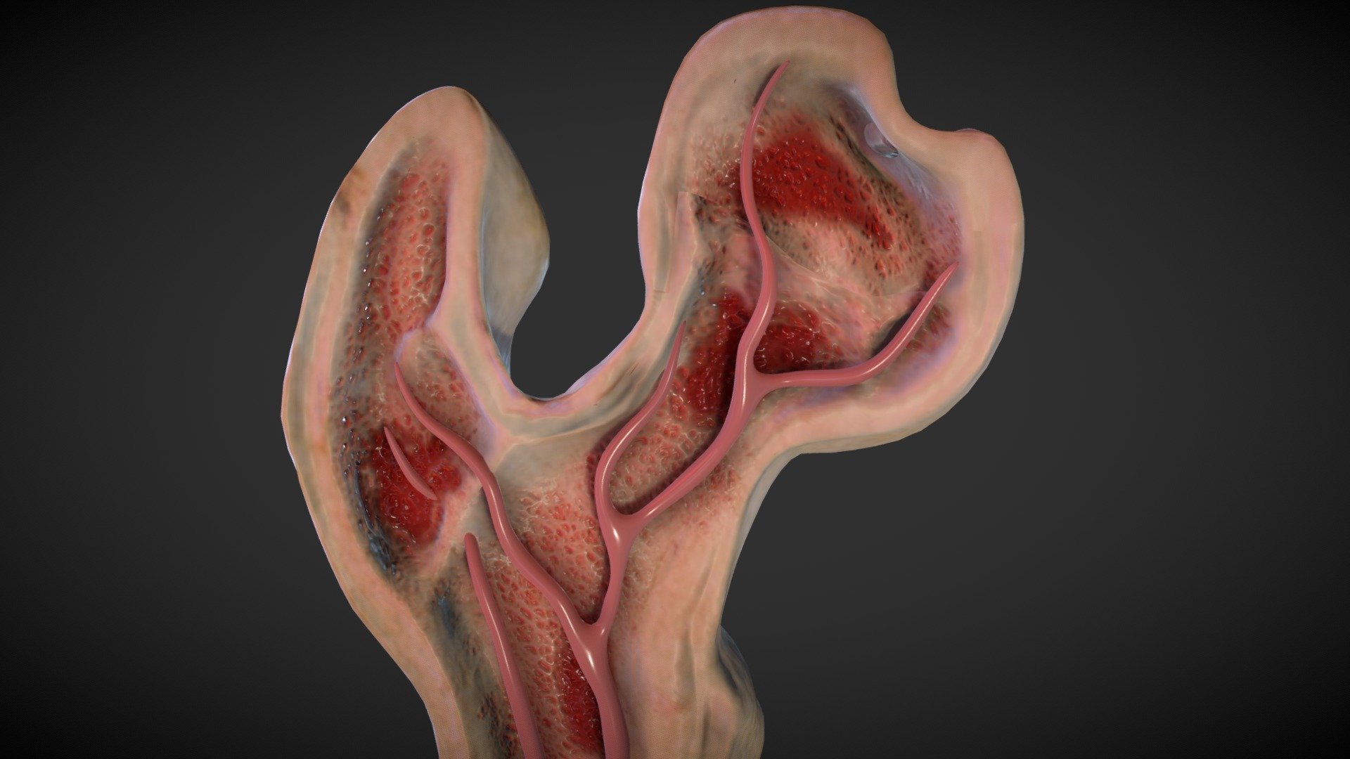 Osteolytic lesion - Buy Royalty Free 3D model by Ebers [c0b1fb6 ...
