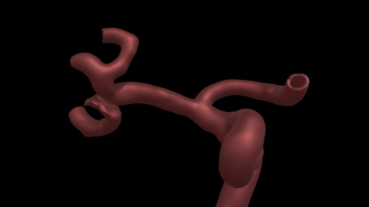 Aneurisma ACM Recanalizado 3D Model