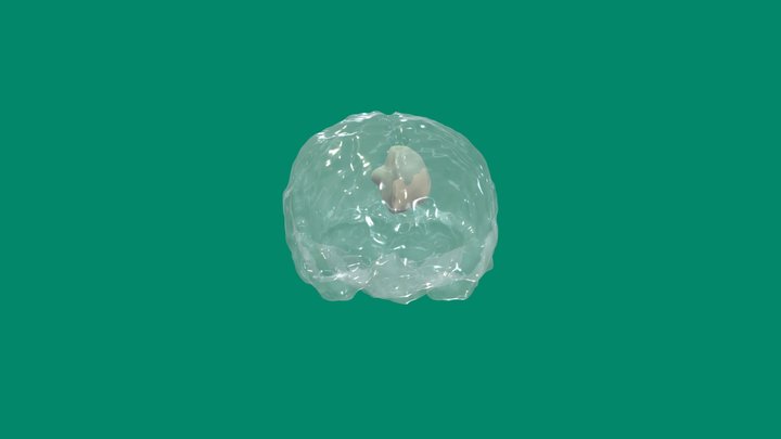 Brain + Tumors 3D Model
