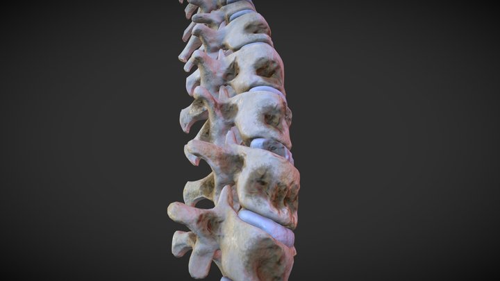 Lytic lesions of spine 3D Model