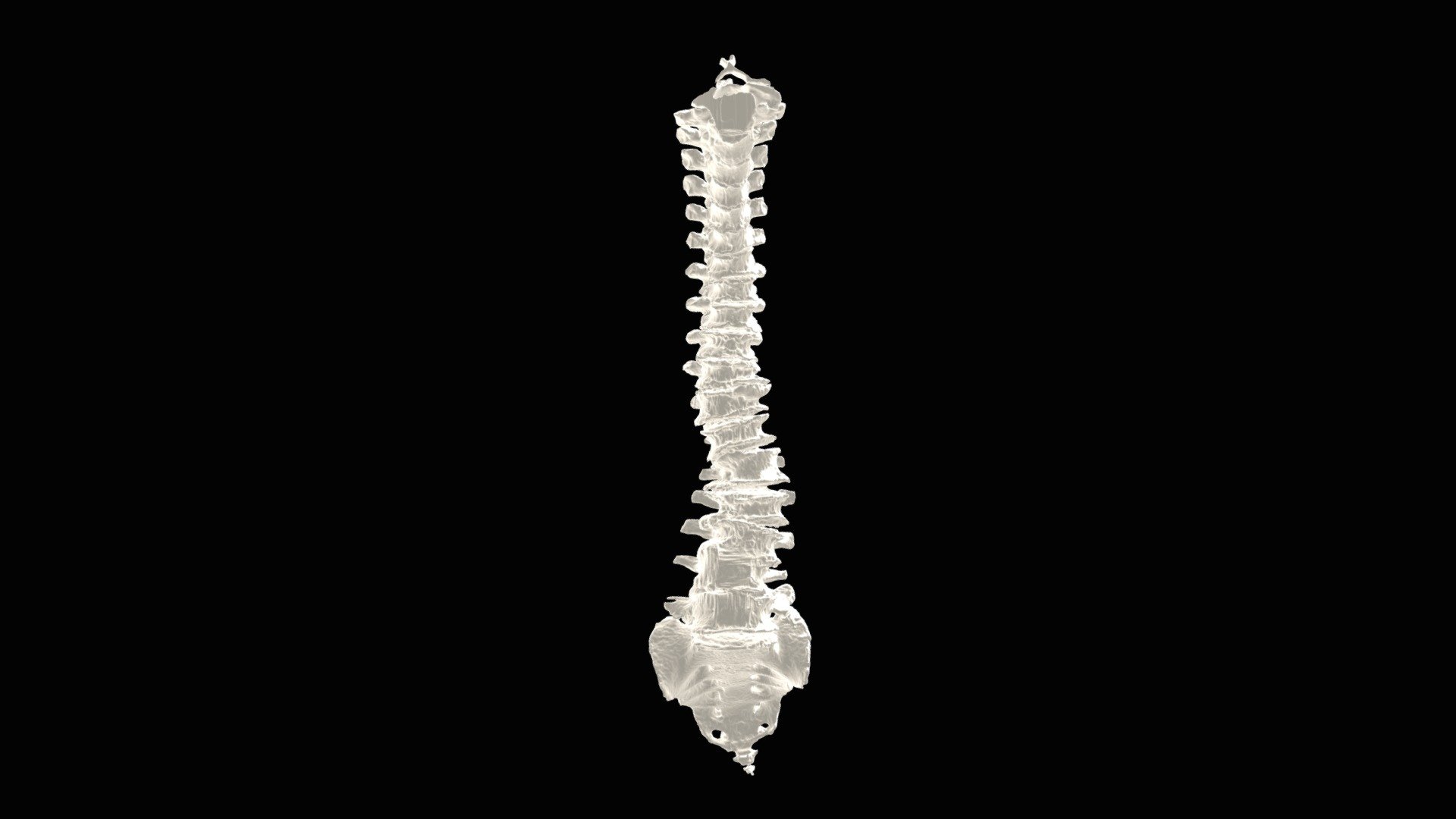 Session 1.02 | De-novo Scoliosis with Robotics