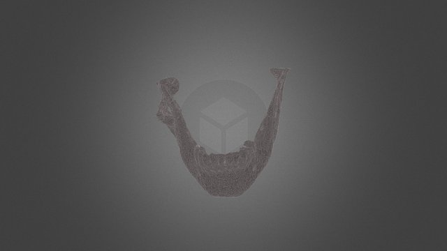 Complex mandible fracture 3D Model
