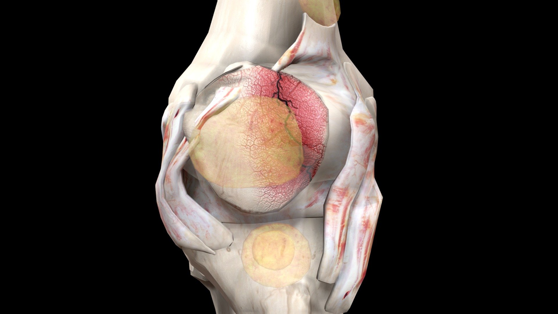 Patellar Fracture: Vertical Fracture - 3D model by Znyth Technologies ...