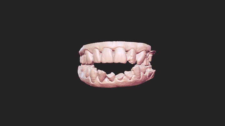 Bite scanned by Thunk3D dental scanner