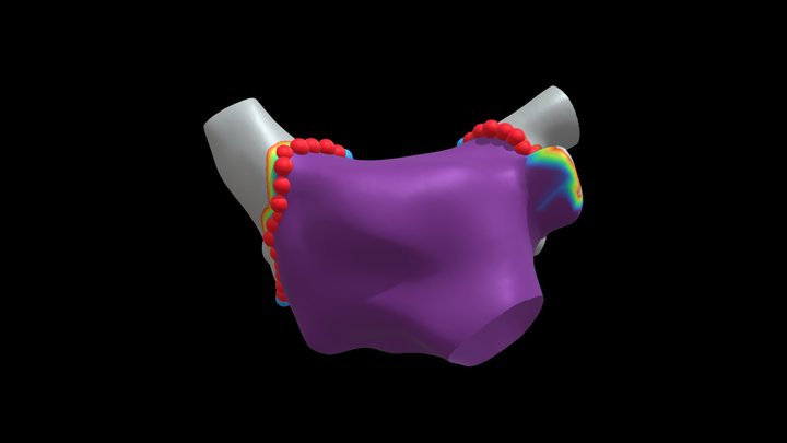 AF Post With Lesions - annotated - Option 2 3D Model
