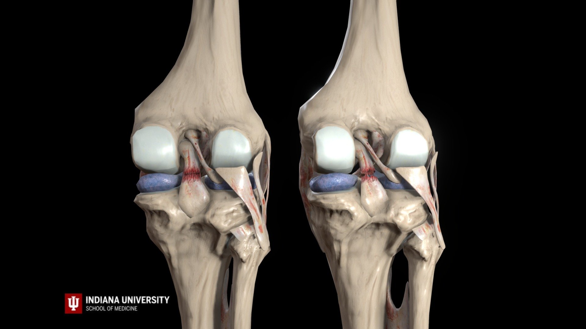 Complete Tear PCL Test 3D model by Connections XR (connectionsxr