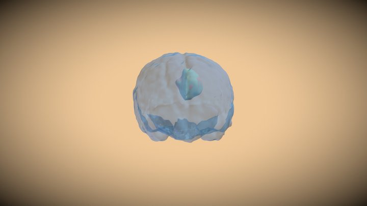 MR Brain Tumors Segmentation 3D Model