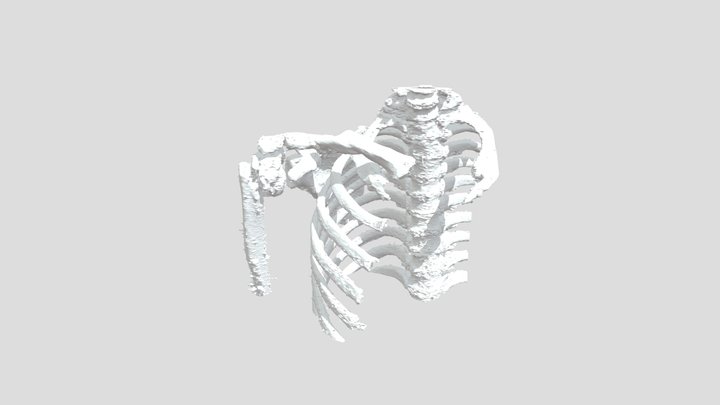 CT 3D SCAN CASE 03_NT HONG (ALL) V3_SMOOTH 3D Model