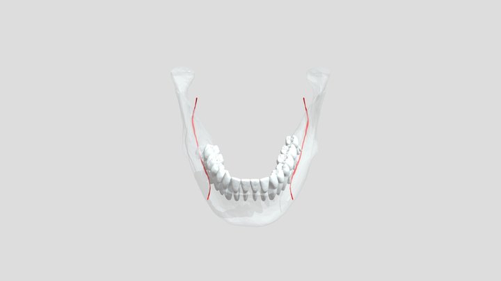 48下颌阻生齿环抱神经 3D Model