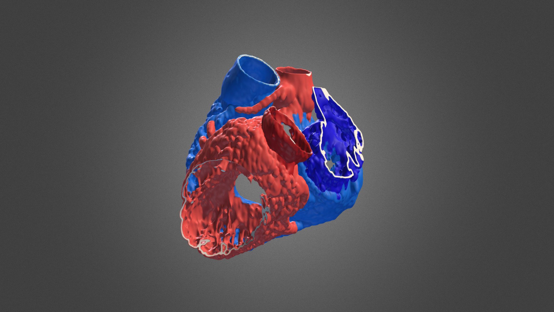 4-chamber multi-VSD - 3D model by shinister [c4655a2] - Sketchfab