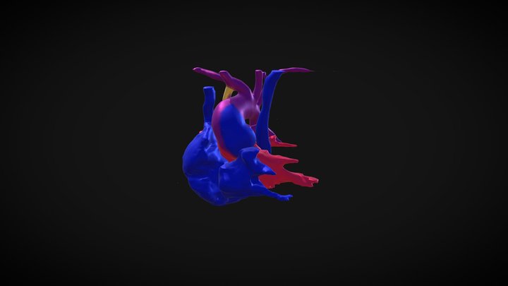 Shunted heart in technicolor 3D Model