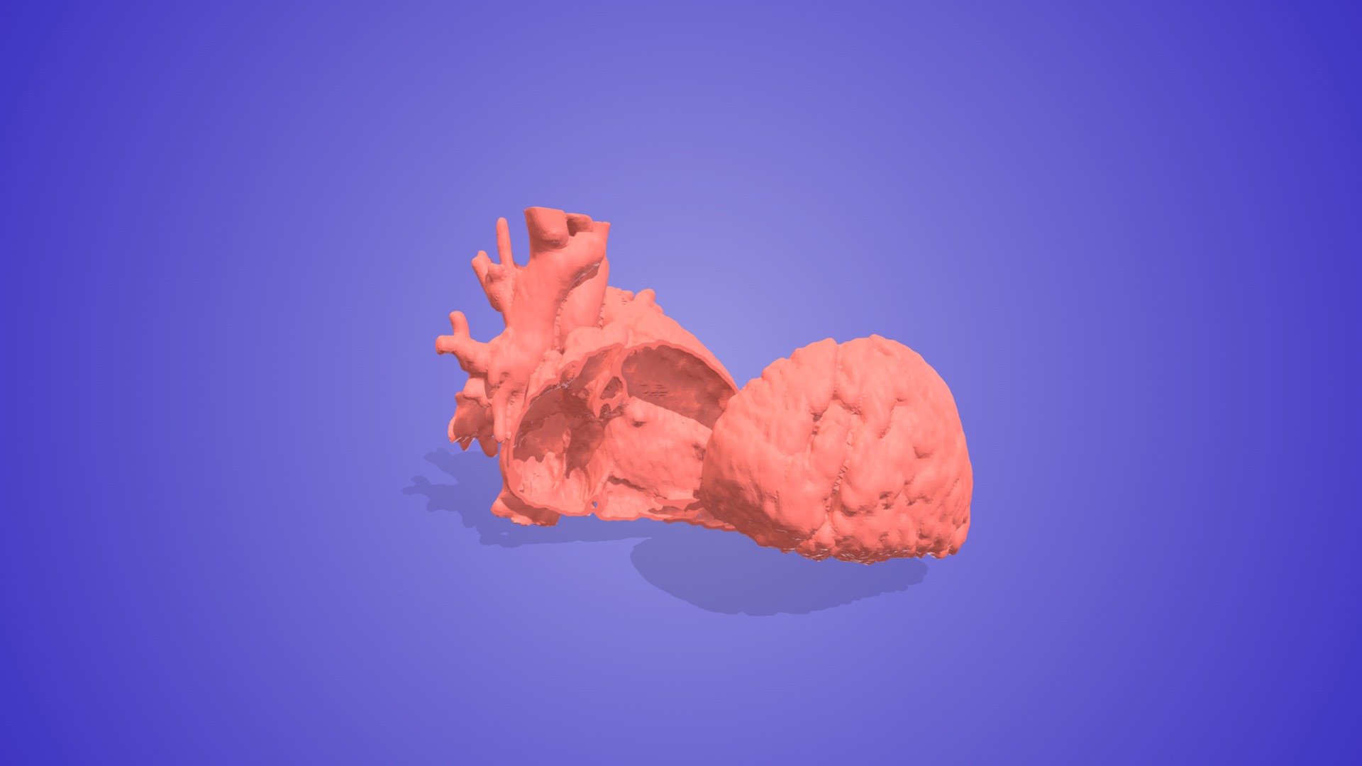 Sinus Venosus Defect