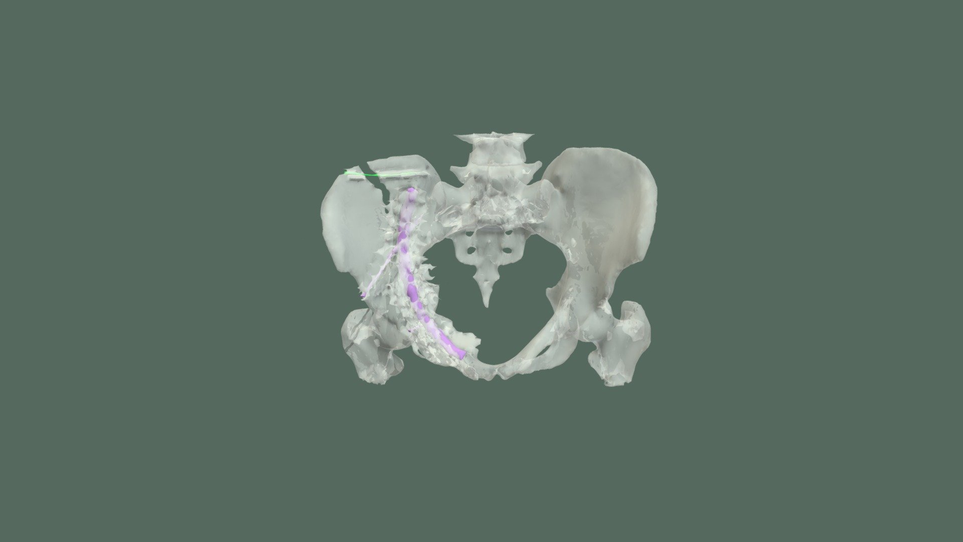 Exam 3 Segmentation of Pelvis