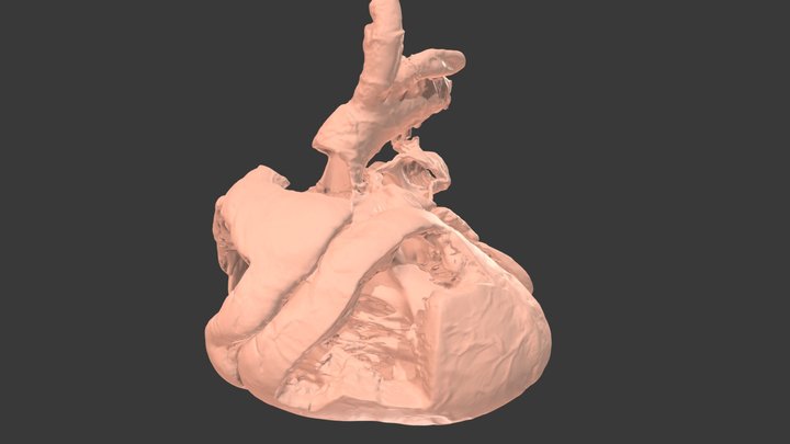 TOF #1 - TOF {S,D,S} with mild RVOTO 3D Model