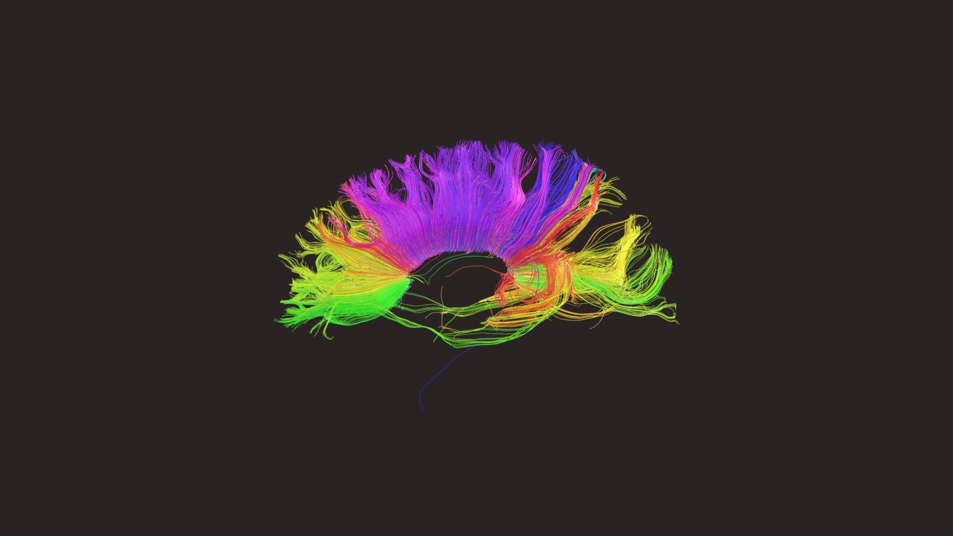 corpus-callosum-tractography-download-free-3d-model-by-quinlancuddy