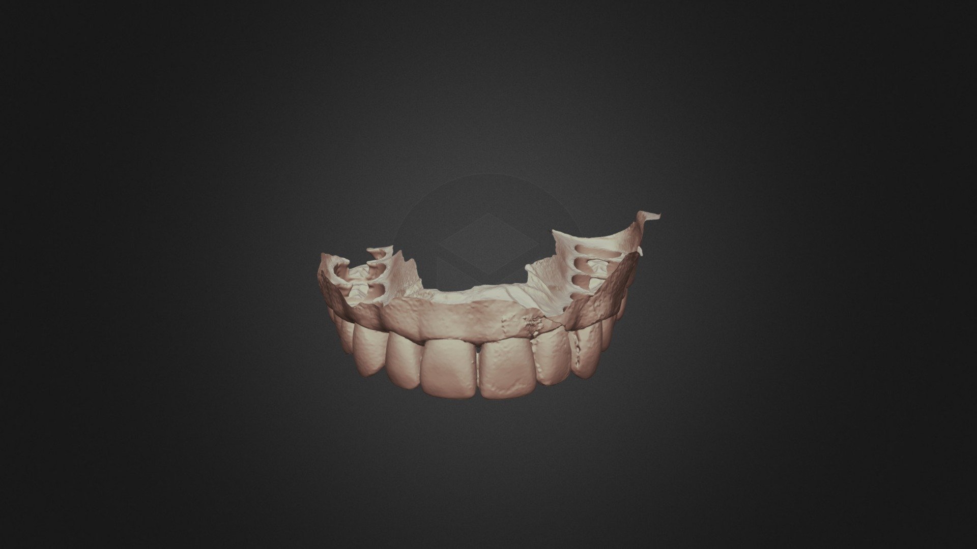 Class3group2 Upper Jaw
