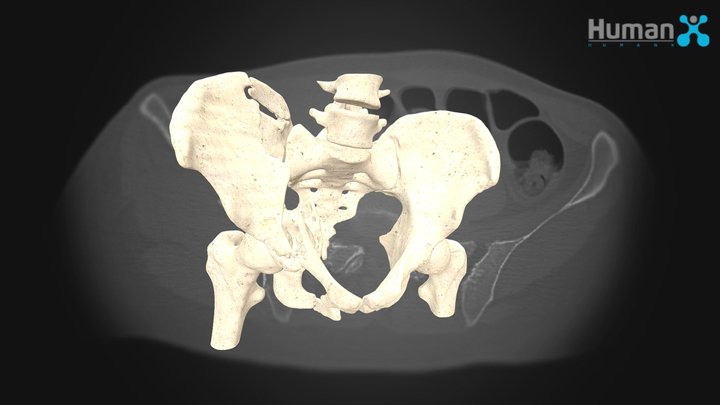 HumanX - Pelvic and Acetabulum Fracture 3D Model