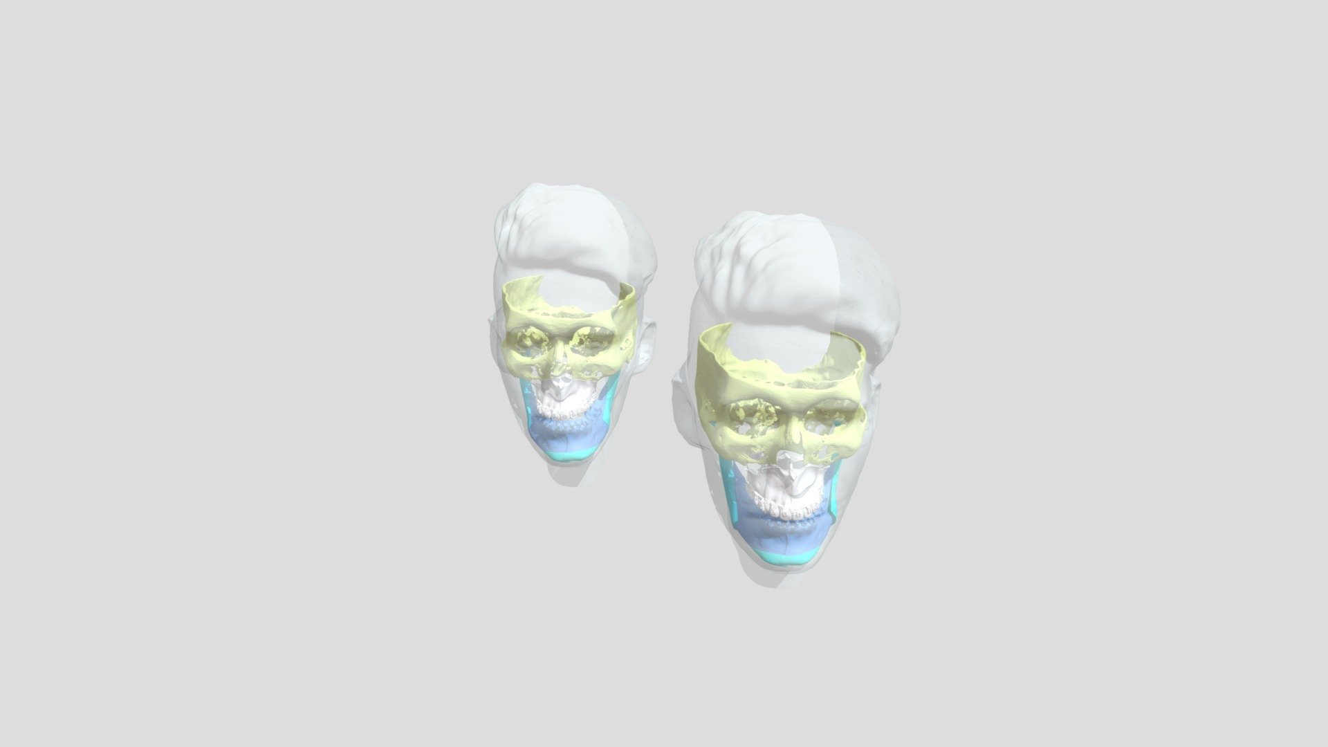 Orthognathic Surgery — Sketchfab embed 3D viewer