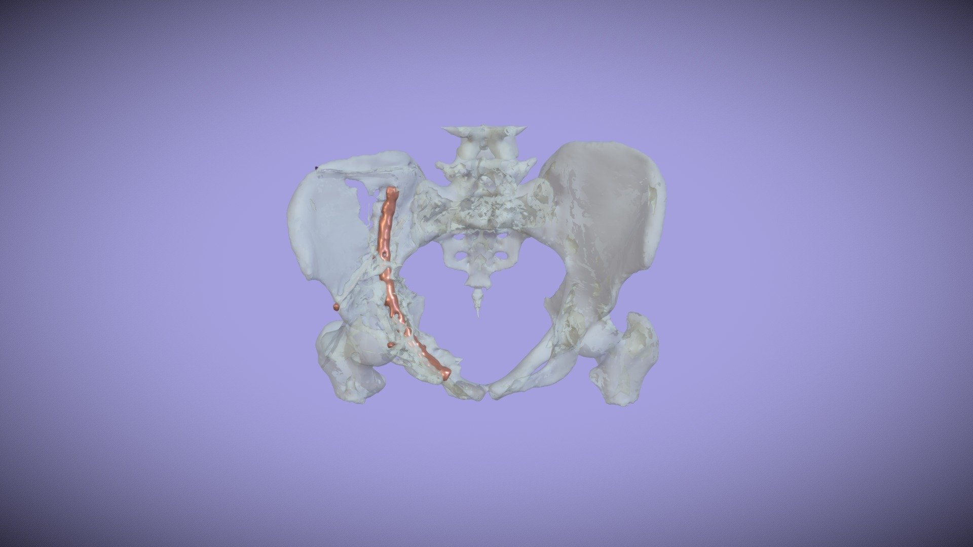 Pelvis Fracture W Hardware Download Free 3d Model By Aimee Kim