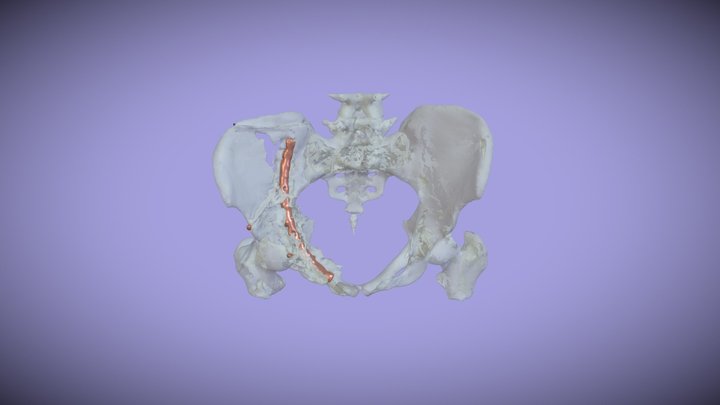 Pelvis Fracture w/Hardware 3D Model