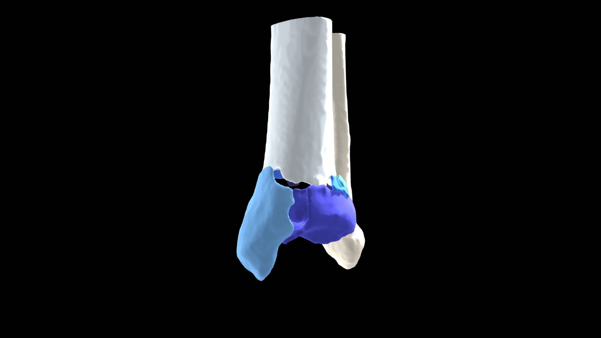 Session 4.05 | dist Tibia - External Fixation