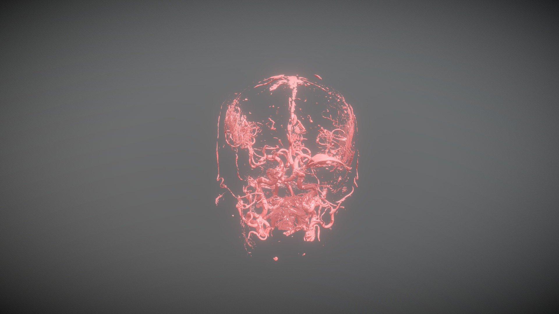 Angiotomography of AICA Aneurysm