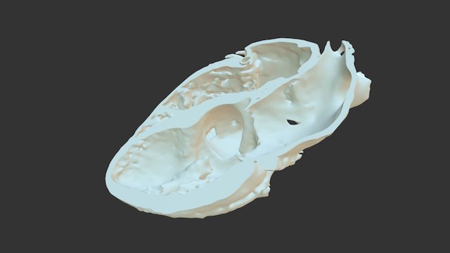 myokardium 4k view with aneurysm 3D Model