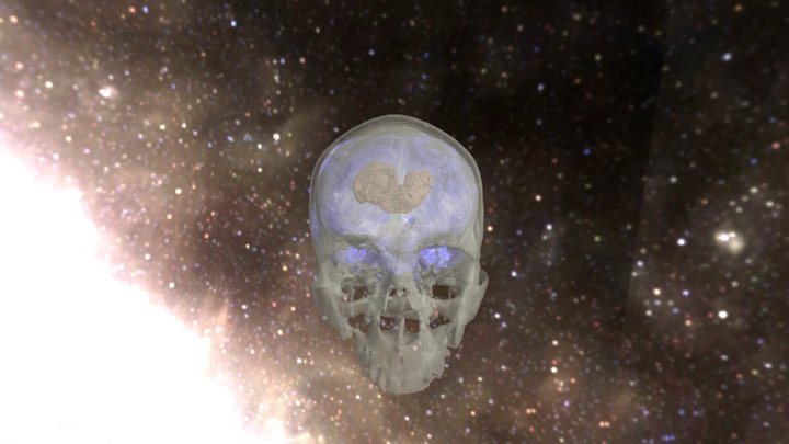 Skull, Brain, And Tumor 3D Model