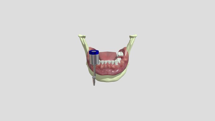 Healing abutment instalation 3D Model