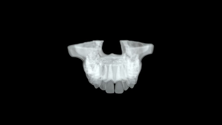 Maxillary Extraction W/ Molar Canal Systems 3D Model