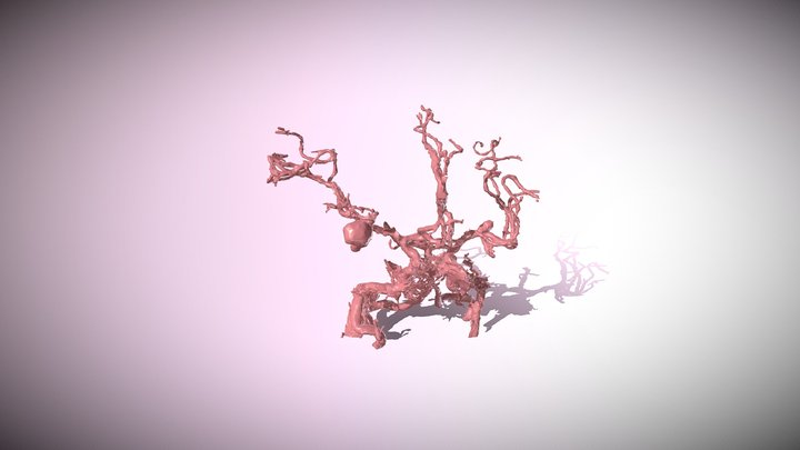 Multiple Cerebral Aneurysms 3D Model
