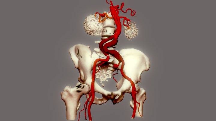 Polydystrophie anévrysmale aorto-iliaque 3D Model