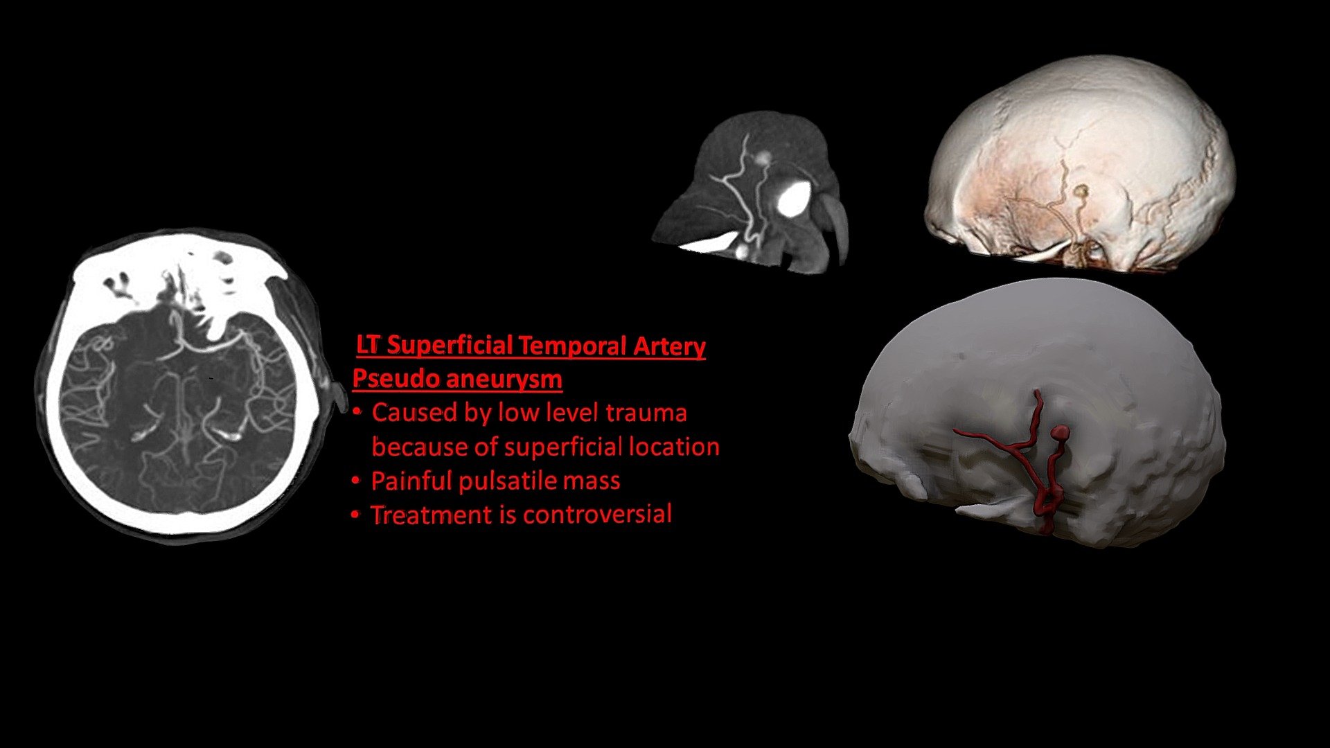 LT Superficial Temporal Artery Pseudo Aneurysm