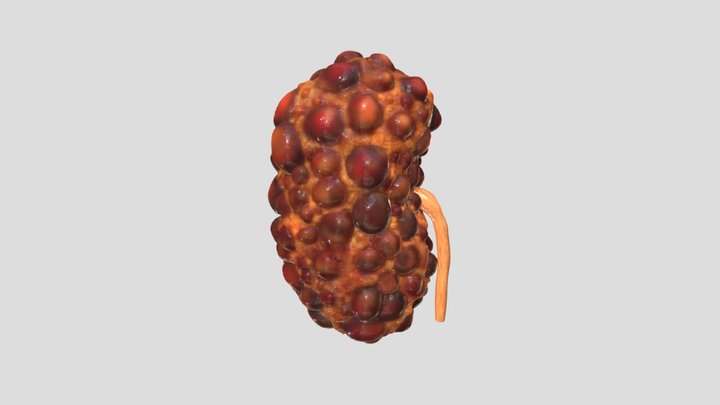 Polycystic Kidney 3D Model