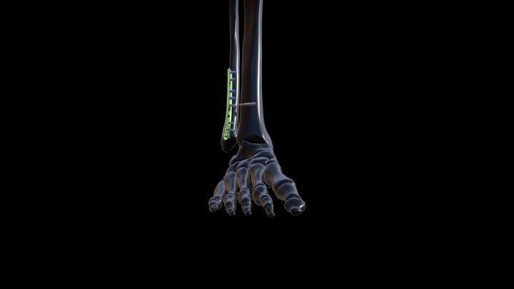 Activ Ankle - Posterolateral Plate 3D Model