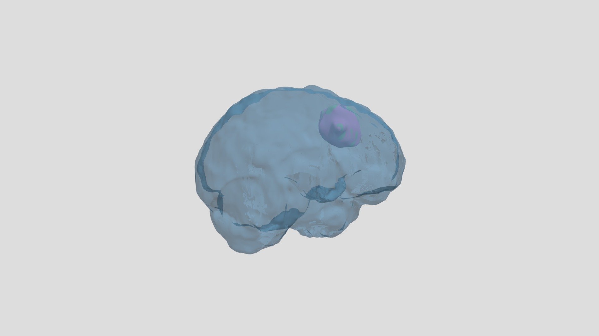 Tumors