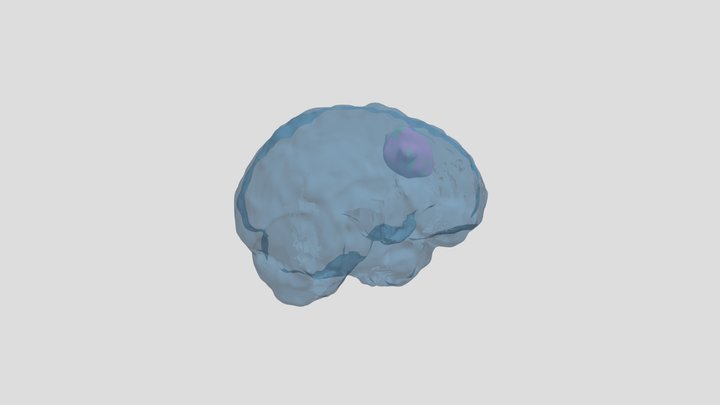 Tumors 3D Model