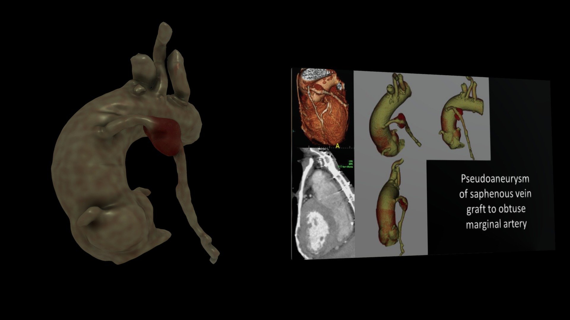 Pseudoaneurysm of Coronary Artery Graft