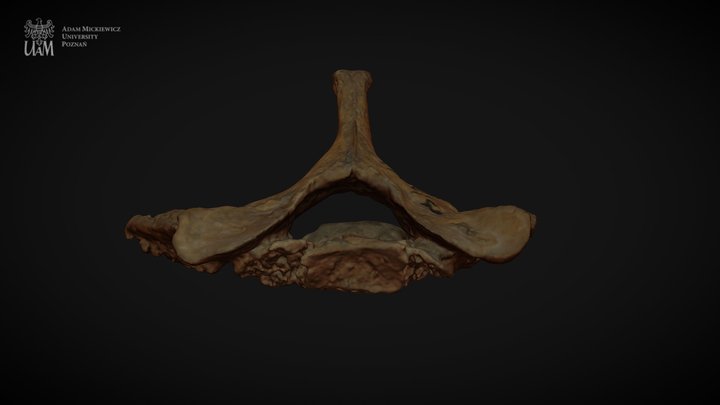 Achondroplastic dwarf - C7 3D Model