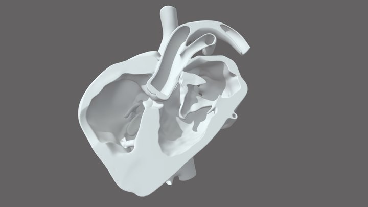 Truncus Arteriosis 3D Model