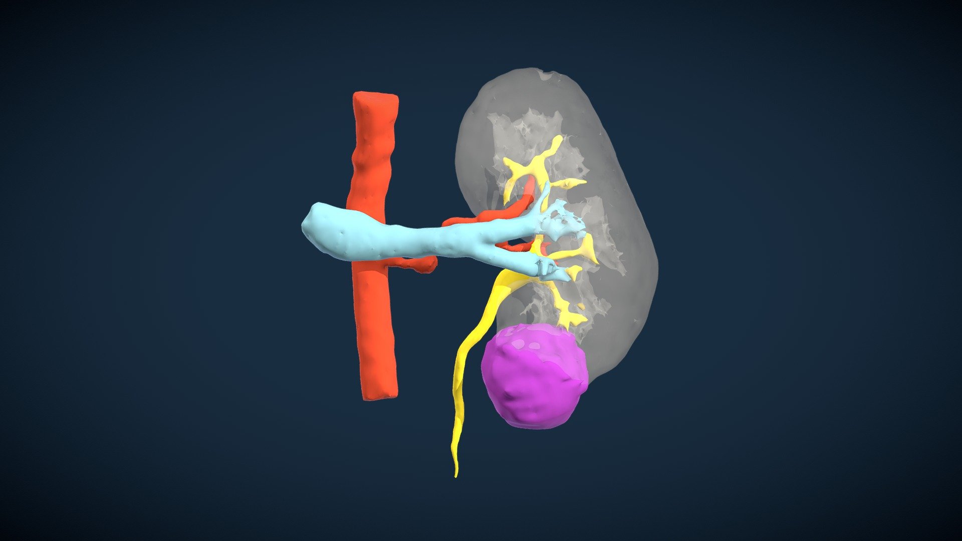 Left Renal Tumor (G.P.V.S.) — Sketchfab embed 3D viewer