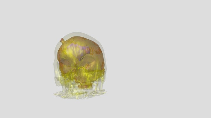 CT Skull-CT Brain-Tumor 3D Model