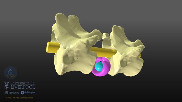 Model_intervertebral_Disk_Normal_Dilated 3D Model