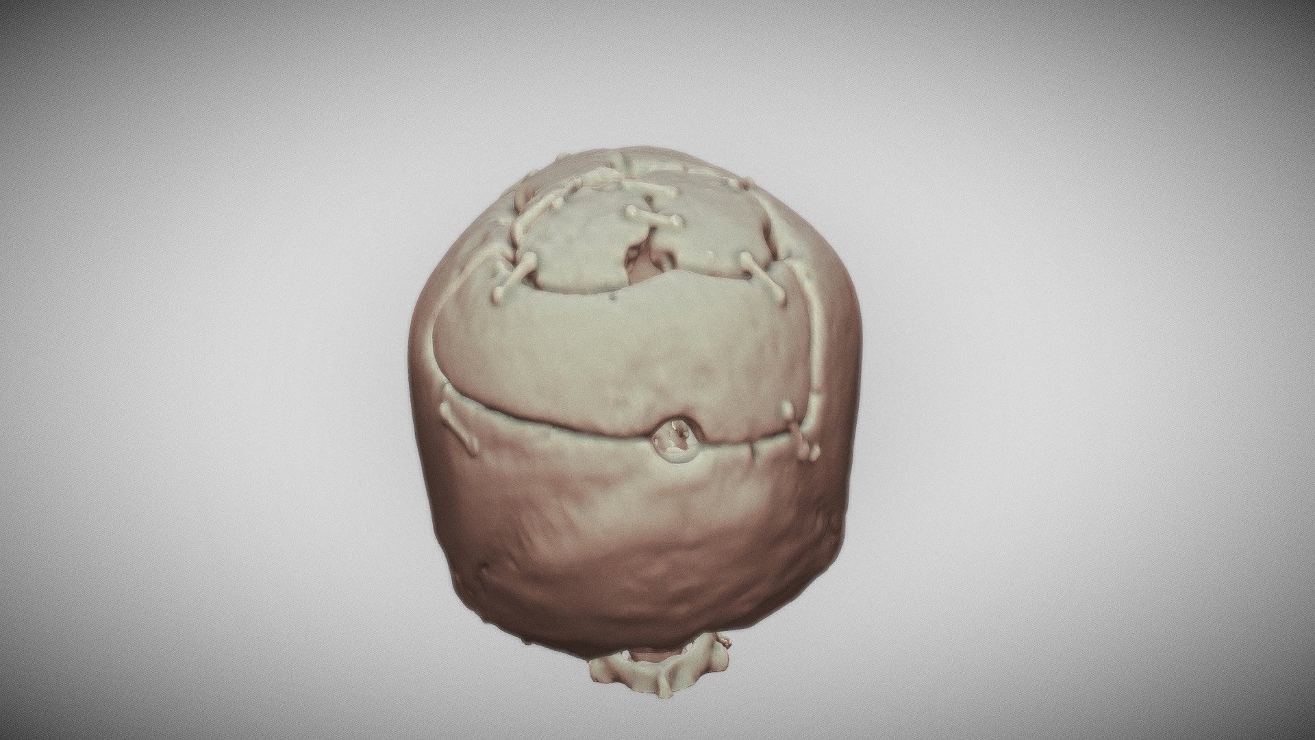 Training Model-Craniotomy For Hematoma Drainage — Sketchfab embed 3D viewer