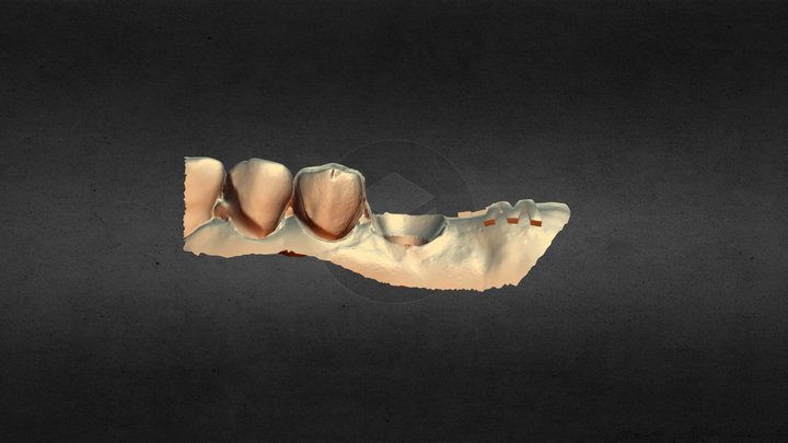 3D IOS implant soft tissue contour 3D Model